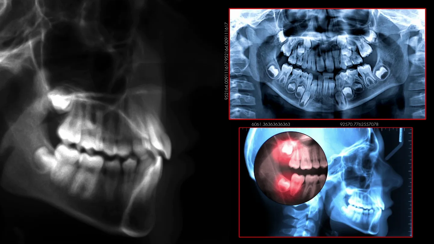 Dental imaging for emergency tooth extraction in Calgary