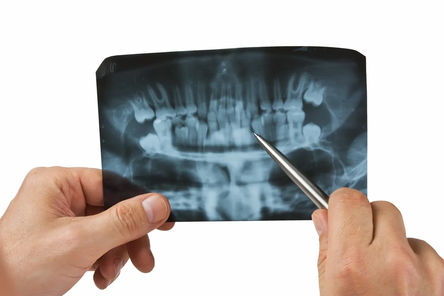 Hands holding dental X-ray image