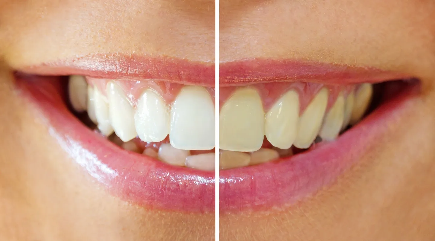 Before and after teeth whitening results at Tooth Bar Calgary