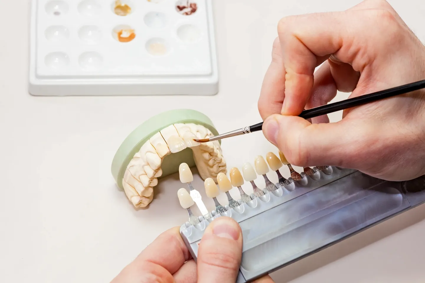 Shade matching for seamless chipped tooth repair at Tooth Bar Calgary